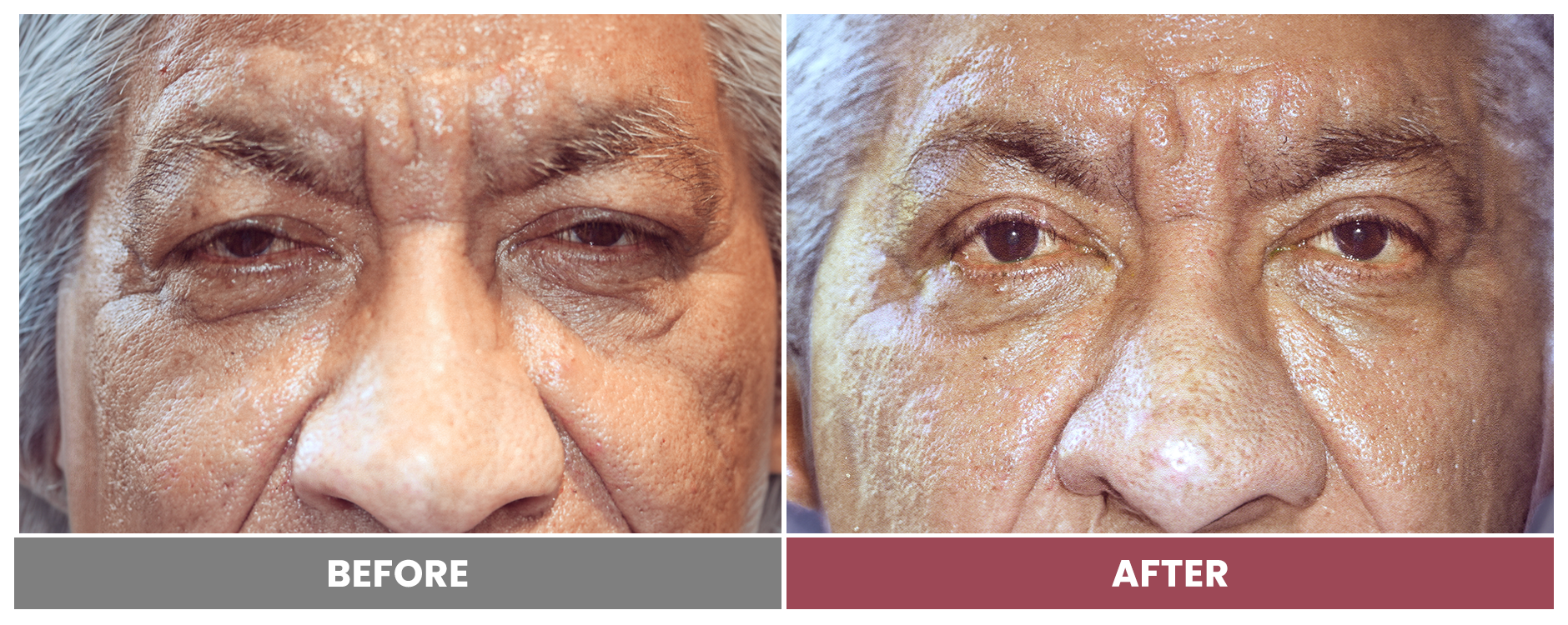 PTOSIS REPAIR - Case 71